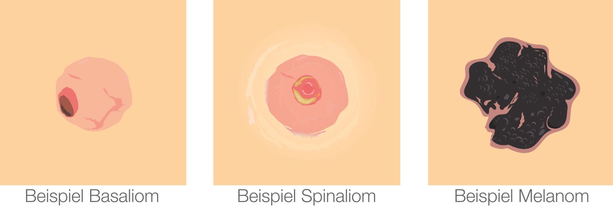 Illustration of a skin tumour, called spinalioma, for medical education.